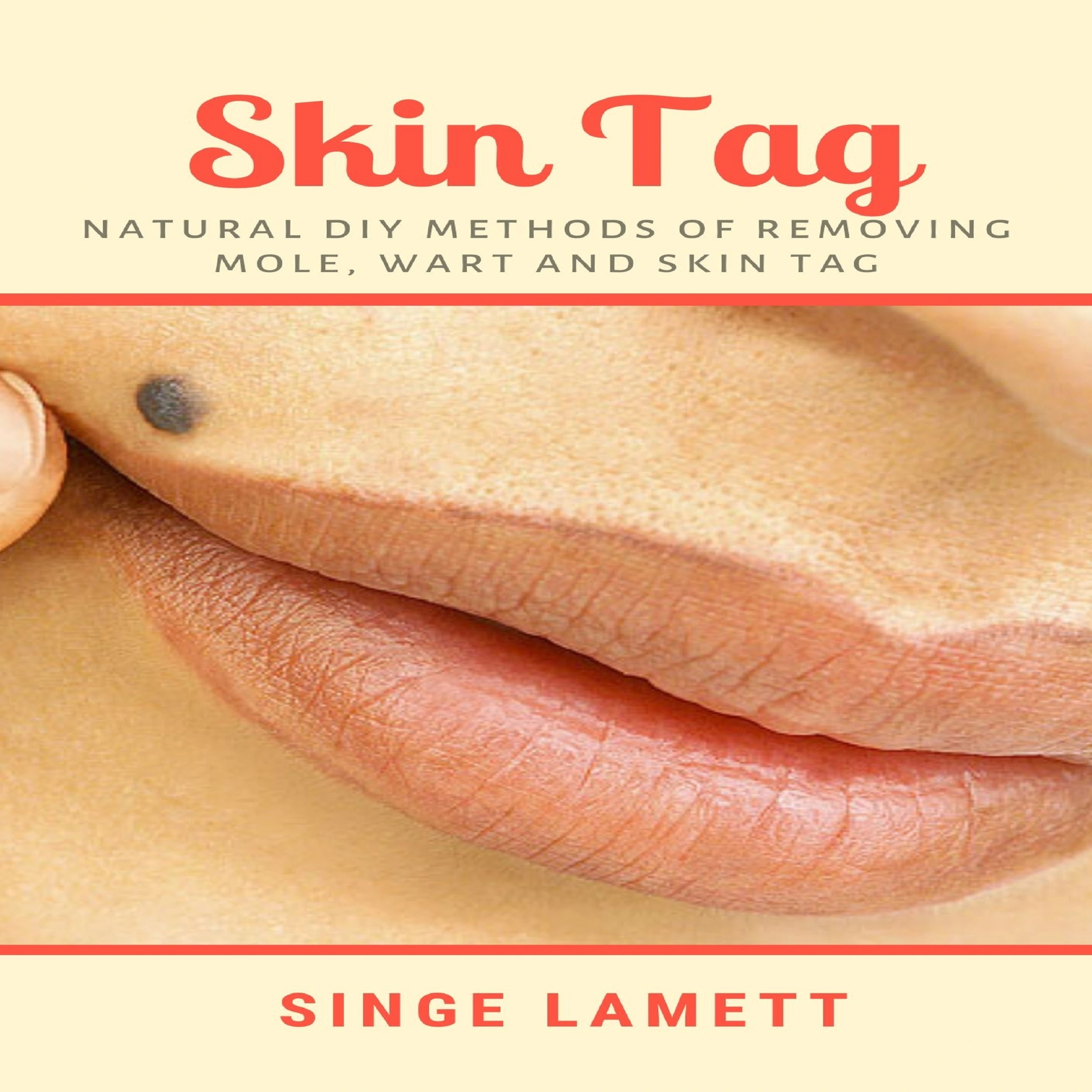 Skin Tag : Natural DIY Methods of removing Mole, Wart and Skin Tag Audiobook by Singe Lamett