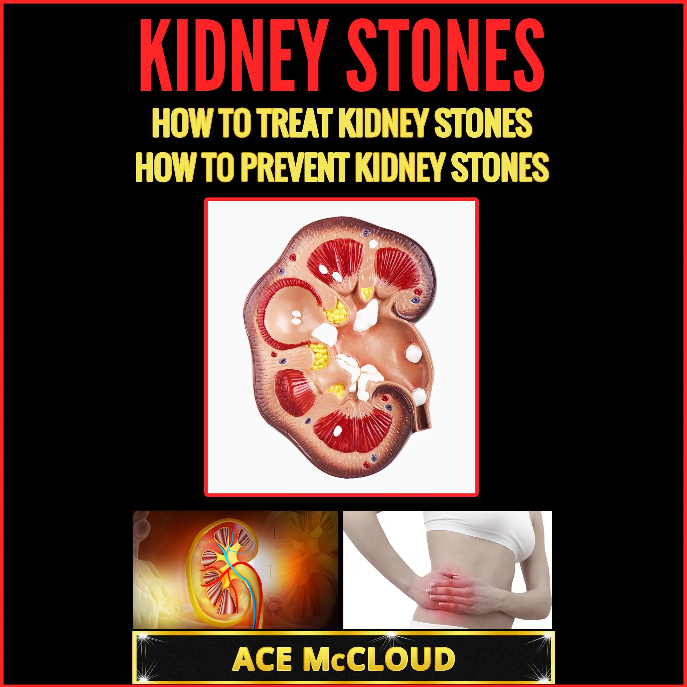 Kidney Stones: How To Treat Kidney Stones: How To Prevent Kidney Stones Audiobook by Ace McCloud