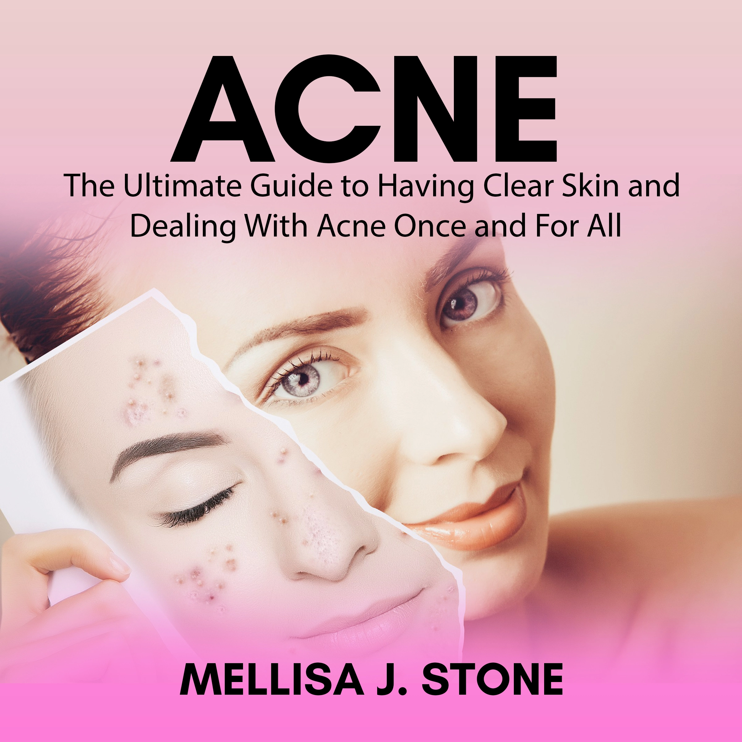 Acne: The Ultimate Guide to Having Clear Skin and Dealing With Acne Once and For All Audiobook by Mellisa J. Stone
