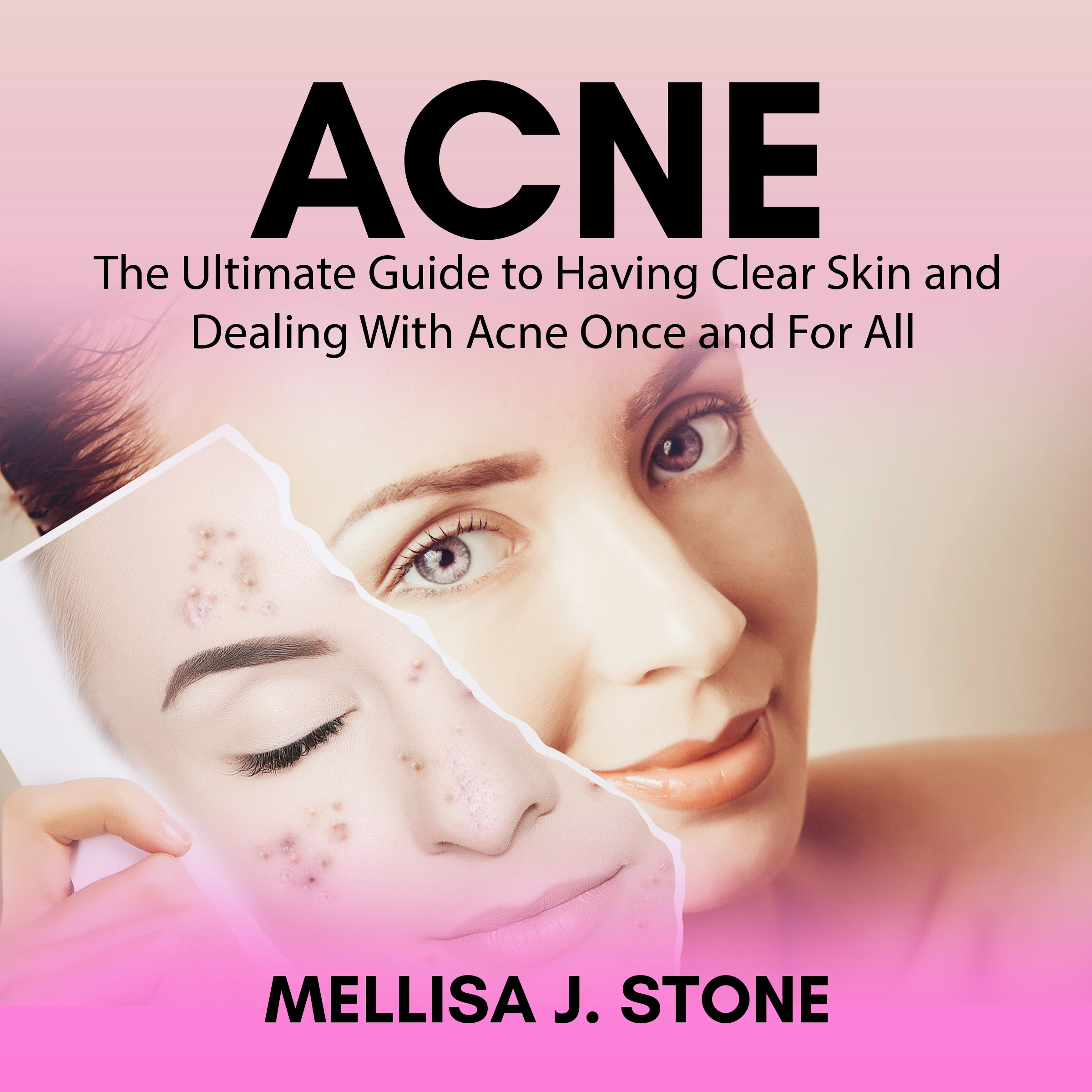 Acne: The Ultimate Guide to Having Clear Skin and Dealing With Acne Once and For All by Mellisa J. Stone